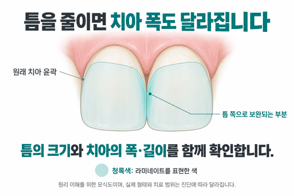 강남역 메이크치과, 돌출된 앞니에도 라미네이트를 할 수 있나요? 관련 이미지 3