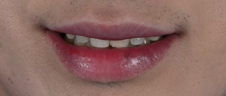 치아미백병원 라미네이트, 조화가 핵심 [+치료 사례 포함] 관련 이미지 2