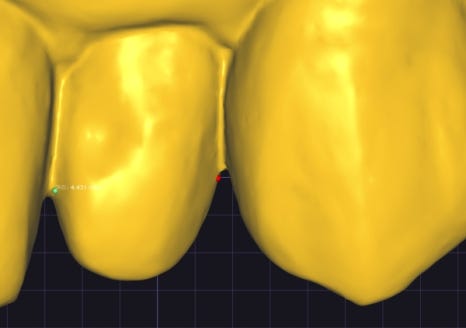 Small Teeth Concerns, Gaining Big Confidence with Small-Tooth Laminates [+Treatment Case Included] image 19