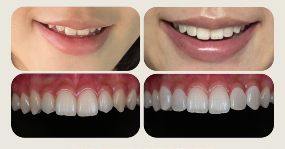 요즘 아이돌/인플루언서 미소가 "자연스럽게 예쁜" 이유 &mdash; 스마일 디자인의 중요성! 관련 이미지 1