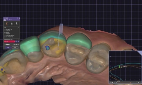 Small Teeth Concerns, Gaining Big Confidence with Small-Tooth Laminates [+Treatment Case Included] image 10