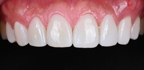 면접 준비의 완성, 치아 벌어짐 교정 [+치료 사례 포함] 관련 이미지 11