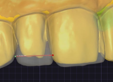 Small Teeth Concerns, Gaining Big Confidence with Small-Tooth Laminates [+Treatment Case Included] image 16