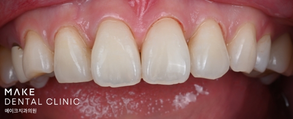 블랙트라이앵글 라미네이트로 완벽한 치아 틈메우기 [ +치료사례 포함] 관련 이미지 13