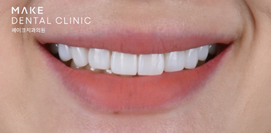 옥니라미네이트, 달라진 미소 [+치료사례 포함] 관련 이미지 18