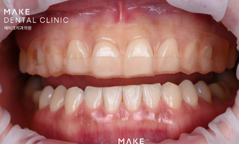 옥니라미네이트, 달라진 미소 [+치료사례 포함] 관련 이미지 6