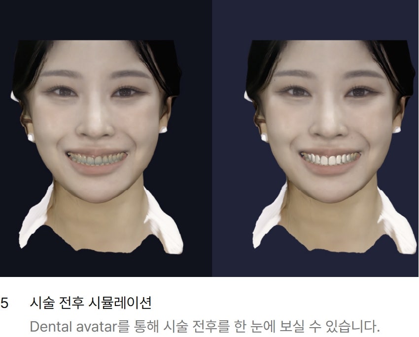블랙트라이앵글 라미네이트로 완벽한 치아 틈메우기 [ +치료사례 포함] 관련 이미지 17