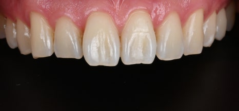 Why Did It Turn Yellow? A Quick Look at the Treatment Process for Discolored Front Teeth [+Treatment Case Included] image 8