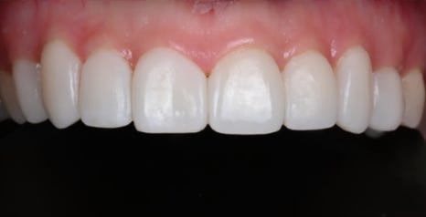 잇몸 라인 비대칭으로 미소의 자신감 회복 [+치료사례 포함] 관련 이미지 15