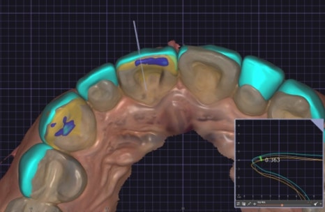 Small Teeth Concerns, Gaining Big Confidence with Small-Tooth Laminates [+Treatment Case Included] image 7