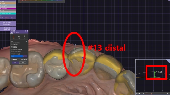 블랙트라이앵글 라미네이트로 완벽한 치아 틈메우기 [ +치료사례 포함] 관련 이미지 6