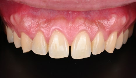 면접 준비의 완성, 치아 벌어짐 교정 [+치료 사례 포함] 관련 이미지 10