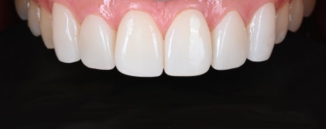 Why Did It Turn Yellow? A Quick Look at the Treatment Process for Discolored Front Teeth [+Treatment Case Included] image 9
