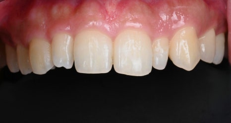 Small Teeth Concerns, Gaining Big Confidence with Small-Tooth Laminates [+Treatment Case Included] image 21