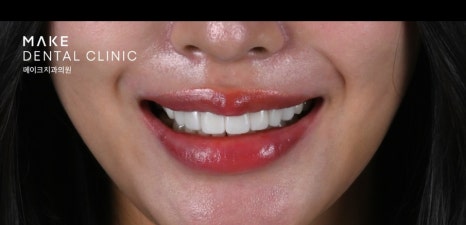 잇몸 라인 비대칭으로 미소의 자신감 회복 [+치료사례 포함] 관련 이미지 6