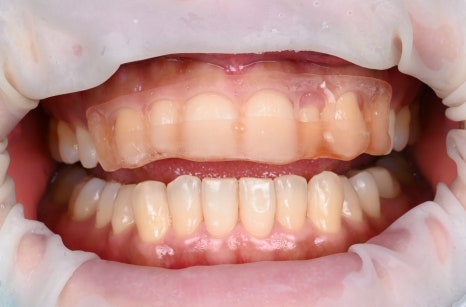 Small Teeth Concerns, Gaining Big Confidence with Small-Tooth Laminates [+Treatment Case Included] image 11