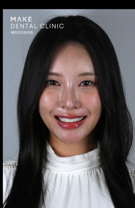잇몸 라인 비대칭으로 미소의 자신감 회복 [+치료사례 포함] 관련 이미지 4