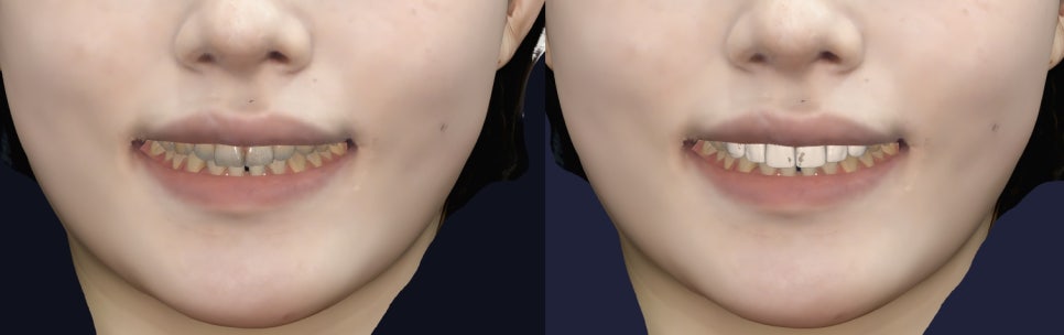 크고 변색된 앞니 고민, 강남라미네이트로 해결했어요 [+치료사례 포함] 관련 이미지 7