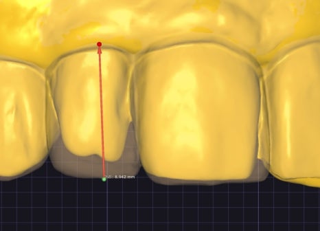 Small Teeth Concerns, Gaining Big Confidence with Small-Tooth Laminates [+Treatment Case Included] image 14
