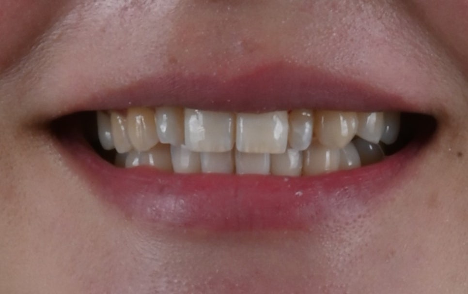 Small Teeth Concerns, Gaining Big Confidence with Small-Tooth Laminates [+Treatment Case Included] image 5