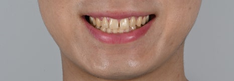 면접 준비의 완성, 치아 벌어짐 교정 [+치료 사례 포함] 관련 이미지 3