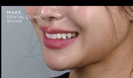 잇몸 라인 비대칭으로 미소의 자신감 회복 [+치료사례 포함] 관련 이미지 16