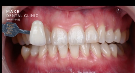 잇몸 라인 비대칭으로 미소의 자신감 회복 [+치료사례 포함] 관련 이미지 12