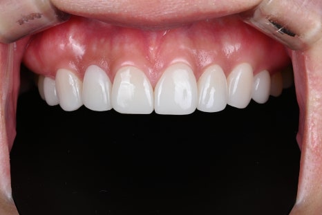 변색과 잇몸비대칭, 라미네이트 치아삭제로 변화를 주다 [+치료 사례 포함] 관련 이미지 10