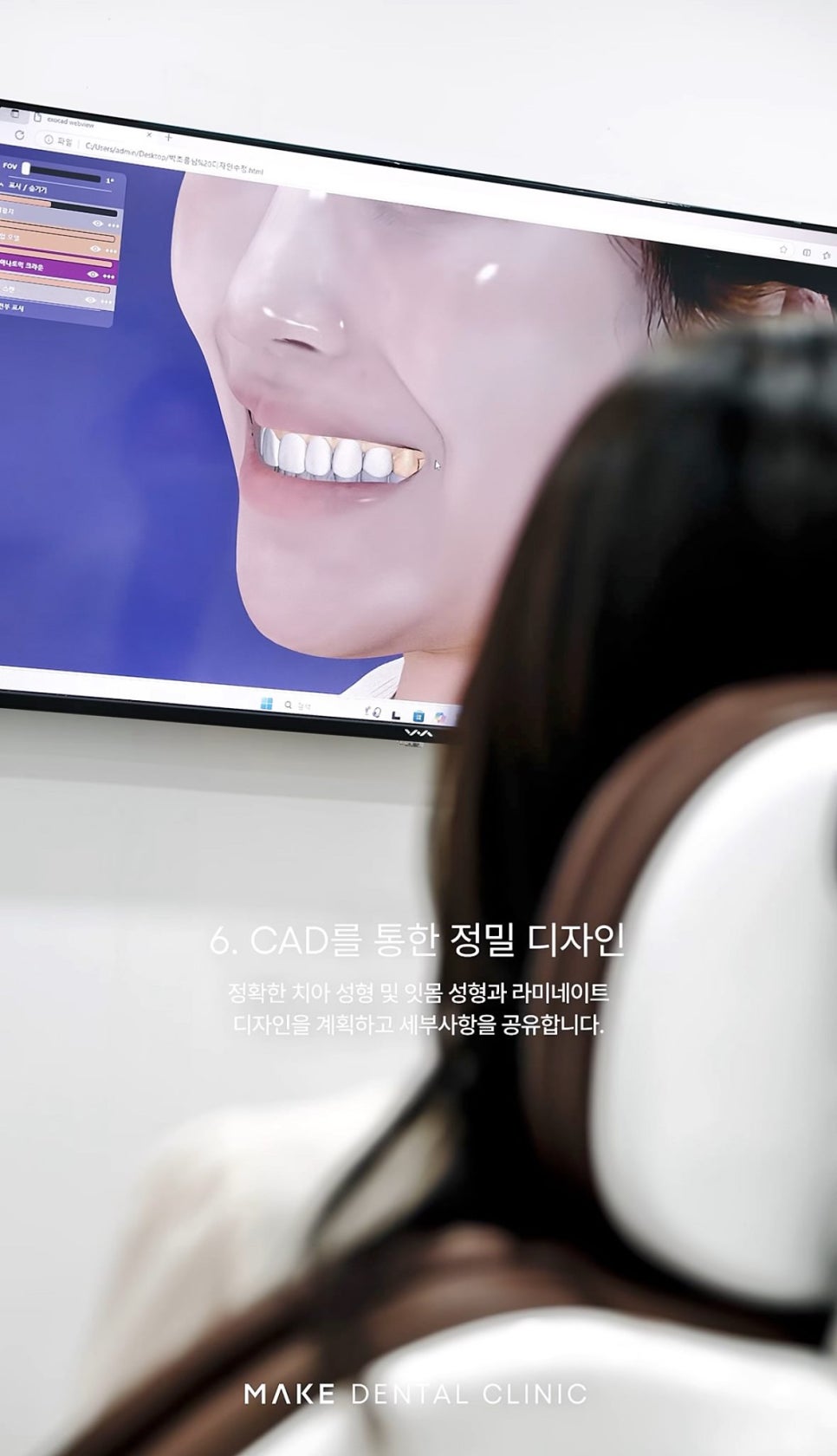 강남논현동치과 라미네이트 재료별 특징과 선택 기준 관련 이미지 3