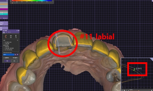 블랙트라이앵글 라미네이트로 완벽한 치아 틈메우기 [ +치료사례 포함] 관련 이미지 5