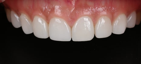 치아마모증 치료, 더 늦어지면 후회할 수밖에 없습니다 [+치료 사례 포함] 관련 이미지 10