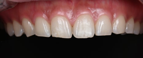 치아마모증 치료, 더 늦어지면 후회할 수밖에 없습니다 [+치료 사례 포함] 관련 이미지 9