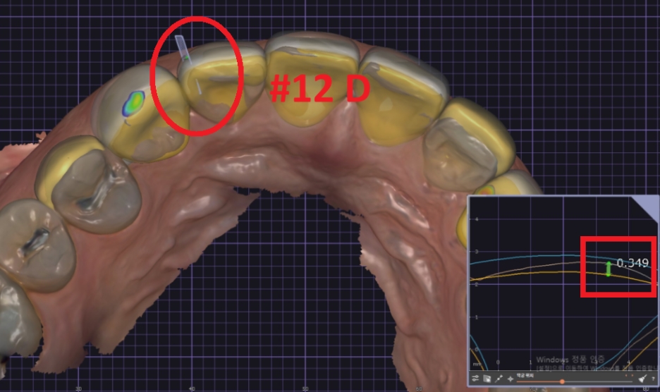 옥니라미네이트, 달라진 미소 [+치료사례 포함] 관련 이미지 10