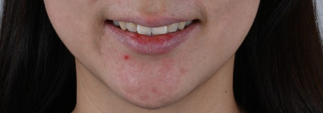 직장인이라면 공감할 고민, 강남치아미백으로 편하게 웃으세요 [+치료 사례 포함] 관련 이미지 9