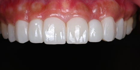 Small Teeth Concerns, Gaining Big Confidence with Small-Tooth Laminates [+Treatment Case Included] image 22