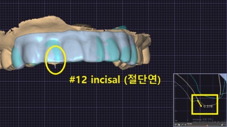 인상이 달라지는 순간, 강남치아미백의 매력 [+치료 사례 포함] 관련 이미지 12