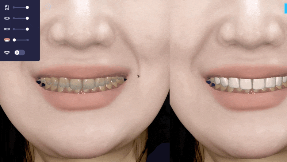 옥니라미네이트, 달라진 미소 [+치료사례 포함] 관련 이미지 7