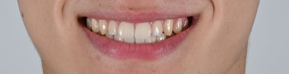 앞니 벌어짐 라미네이트 삭제 걱정 끝 [+치료 사례 포함] 관련 이미지 13