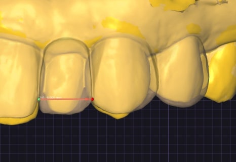 Small Teeth Concerns, Gaining Big Confidence with Small-Tooth Laminates [+Treatment Case Included] image 20