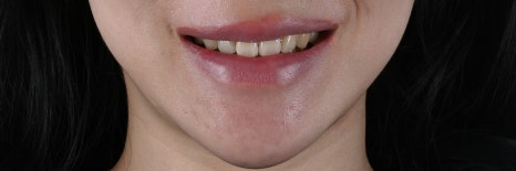 변색과 잇몸비대칭, 라미네이트 치아삭제로 변화를 주다 [+치료 사례 포함] 관련 이미지 2