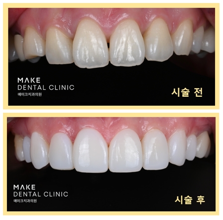 블랙트라이앵글 라미네이트로 완벽한 치아 틈메우기 [ +치료사례 포함] 관련 이미지 16