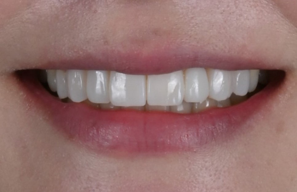 Small Teeth Concerns, Gaining Big Confidence with Small-Tooth Laminates [+Treatment Case Included] image 23