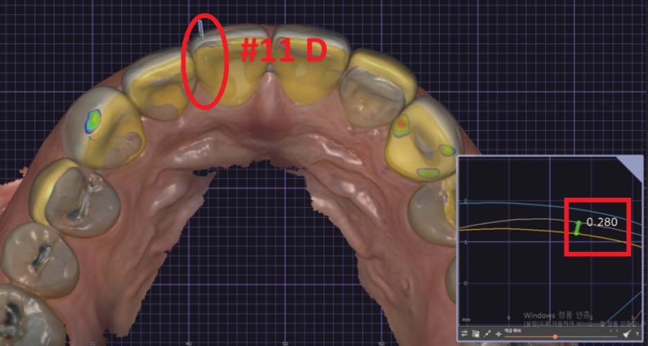 옥니라미네이트, 달라진 미소 [+치료사례 포함] 관련 이미지 9