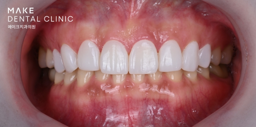 옥니라미네이트, 달라진 미소 [+치료사례 포함] 관련 이미지 16