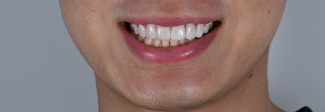 면접 준비의 완성, 치아 벌어짐 교정 [+치료 사례 포함] 관련 이미지 4