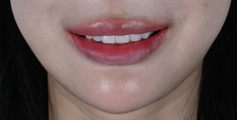 치아부분변색 때문에 웃지 못했던 하루, 이렇게 바뀌었습니다 [+치료 사례 포함] 관련 이미지 9