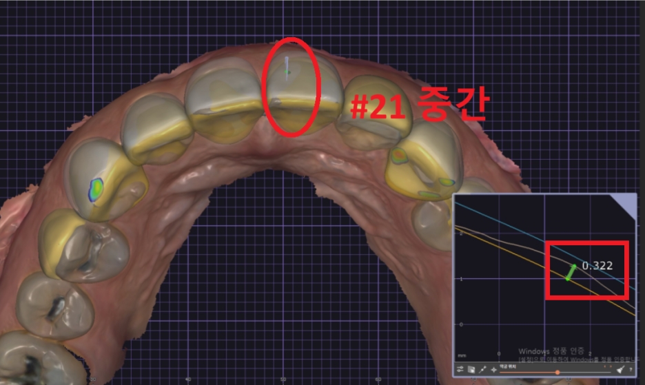 옥니라미네이트, 달라진 미소 [+치료사례 포함] 관련 이미지 12