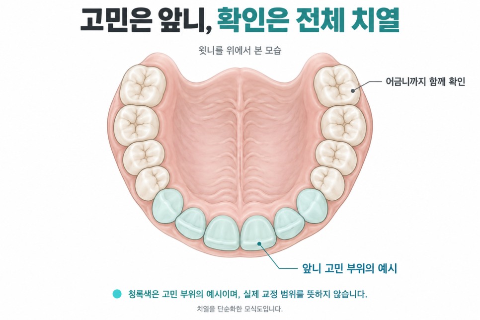 논현동 메이크치과, 전체 교정 말고 앞니만 부분교정할 수도 있나요? 관련 이미지 2