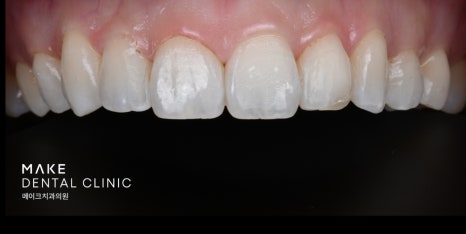잇몸 라인 비대칭으로 미소의 자신감 회복 [+치료사례 포함] 관련 이미지 9