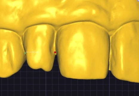 Small Teeth Concerns, Gaining Big Confidence with Small-Tooth Laminates [+Treatment Case Included] image 15